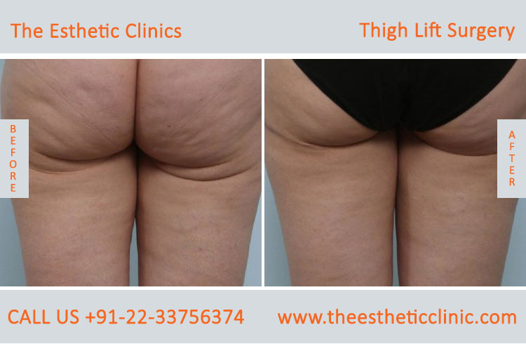 Thigh Lift Surgery, Thigh Reduction before after photos in mumbai india (4)